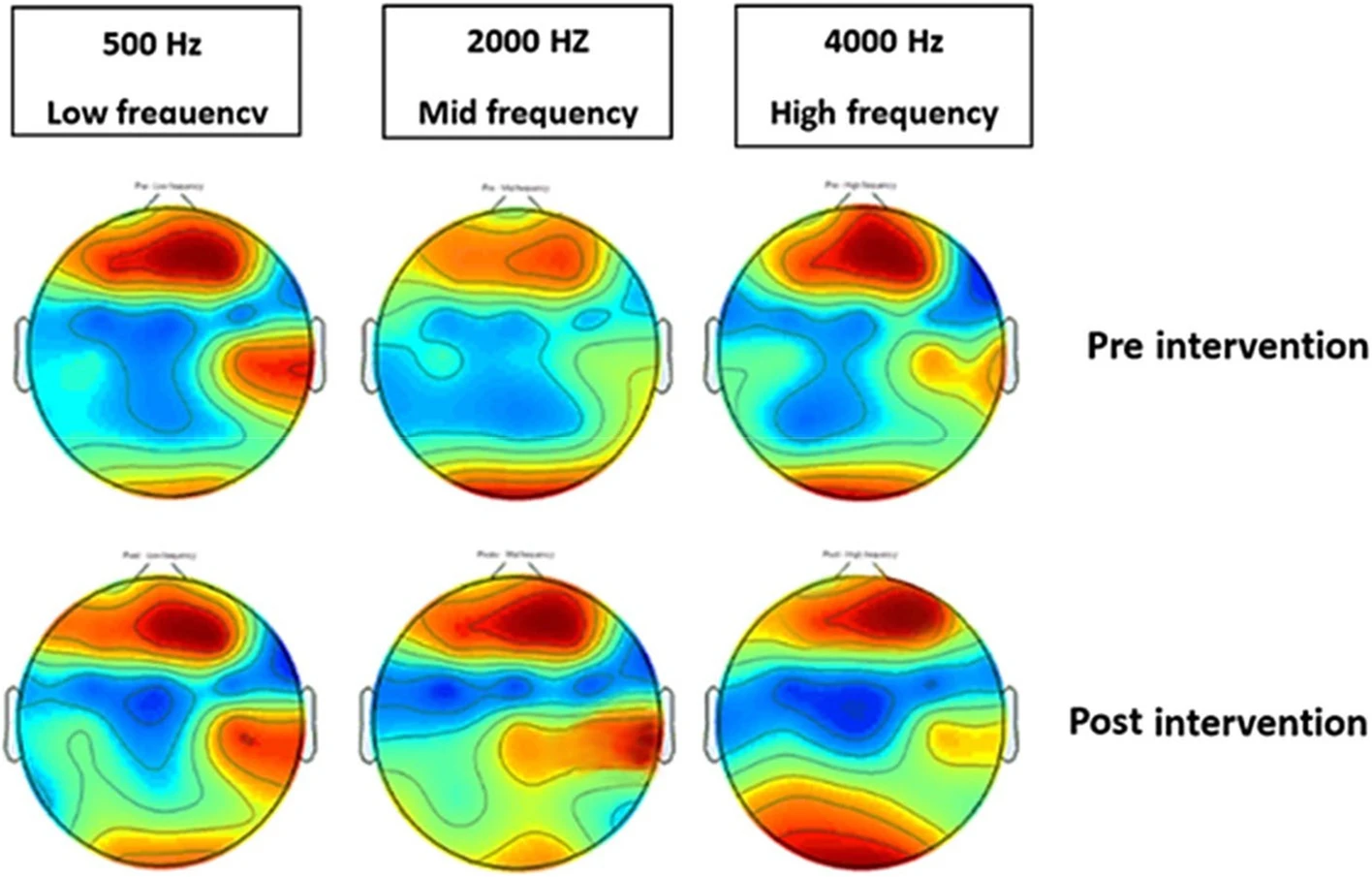 EEG-Messung zur Untersuchung der Auswirkungen von binauralen Beats auf die interhemisphärische Kohärenz im Alpha-Band.